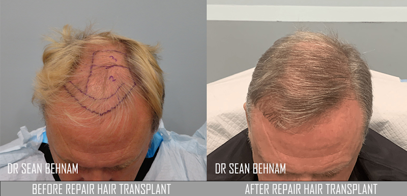 Hair Transplant Los Angeles Dr. Sean Behnam cover image