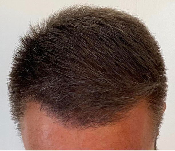 Hair Transplants Los Angeles cover image