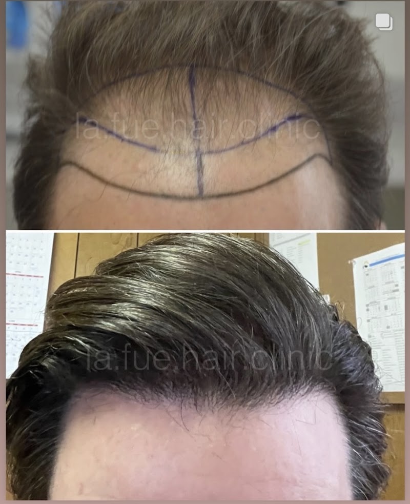 LA FUE Hair Clinic - Los Angeles FUE Hair Transplant Clinic cover image