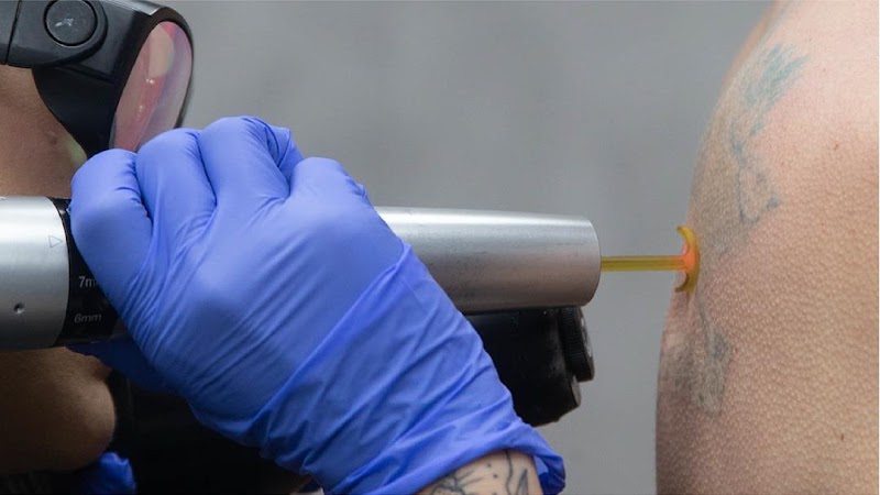 Removery Tattoo Removal & Fading cover image