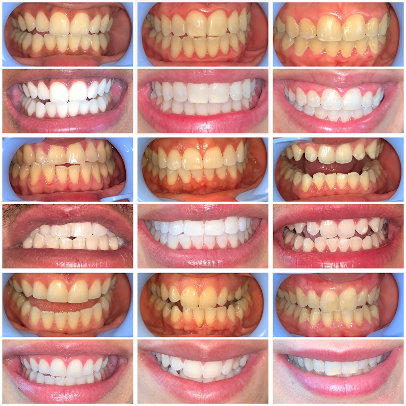 Moe's Teeth Whitening cover image