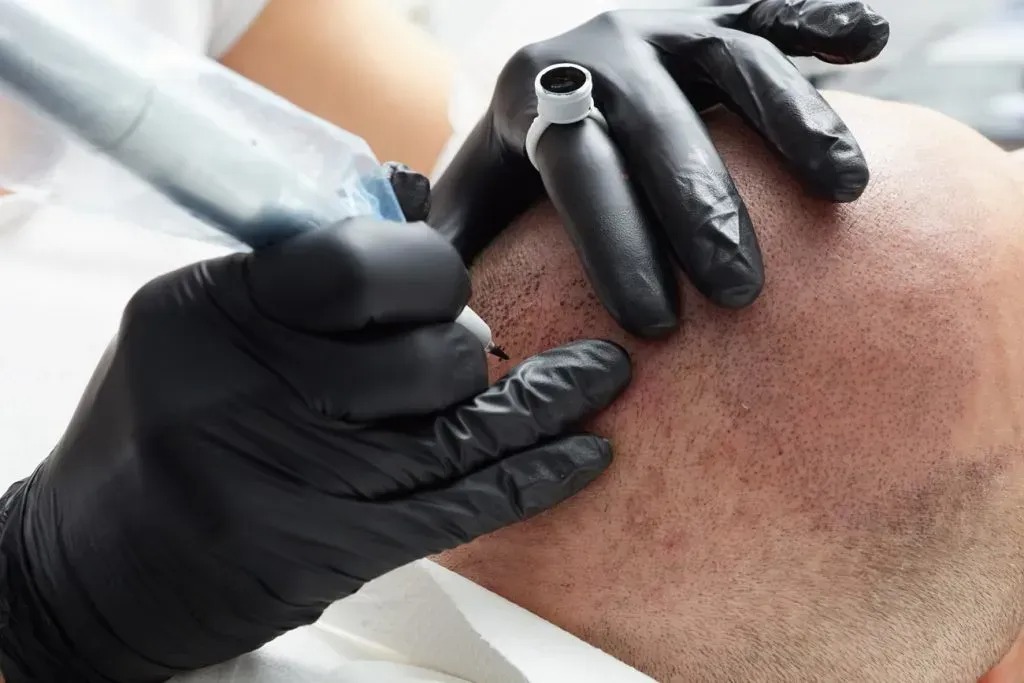 Scalpmasters - Scalp Micropigmentation Hair Clinic cover