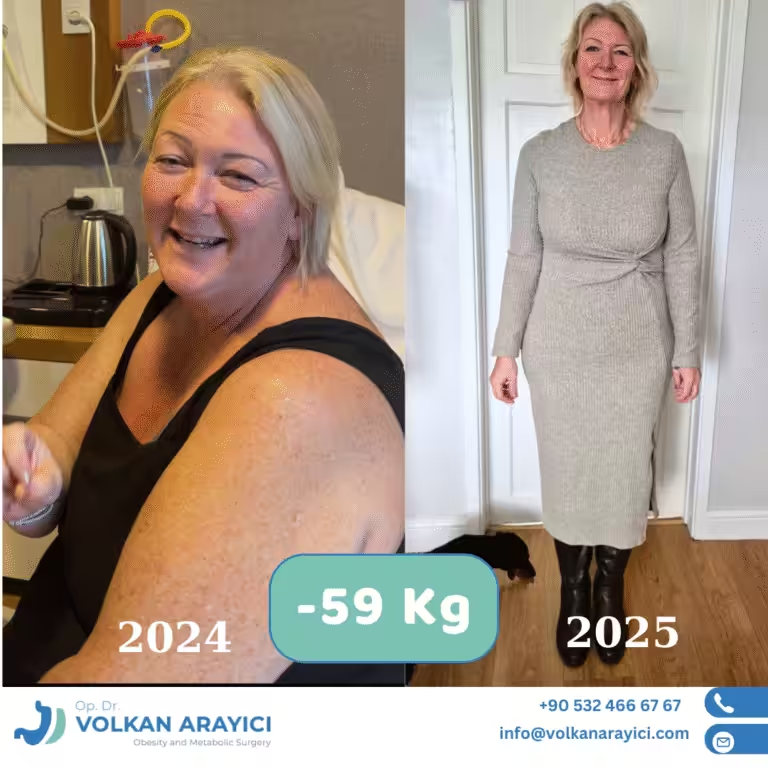 Op. Dr. Volkan Arayıcı - Tüp Mide ameliyatı - Magenverkleinerung Türkei - Gastric Sleeve cover